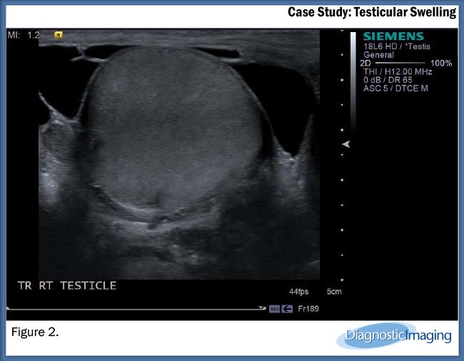Testicular Swelling