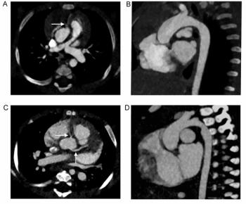 Study: Photon-Counting CT Reduces Radiation Dosing by More than 40 Percent in Kids with Congenital Heart Disease