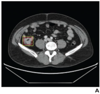 Can CT-Based AI Provide Automated Detection of Colorectal Cancer?