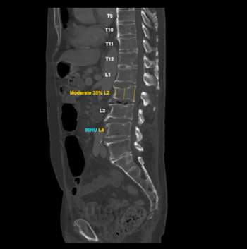 Nanox Adds AI Applications to Teleradiology Platform for CT Second Opinions 