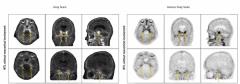 FDA Approves New Tau PET Imaging Agent for Alzheimer’s Disease