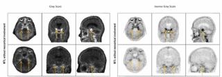 FDA Approves New Tau PET Imaging Agent for Alzheimer’s Disease