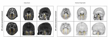 FDA Approves New Tau PET Imaging Agent for Alzheimer’s Disease