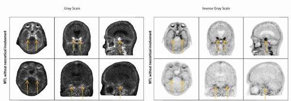 FDA Approves New Tau PET Imaging Agent for Alzheimer’s Disease
