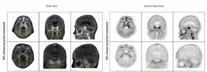 FDA Approves New Tau PET Imaging Agent for Alzheimer’s Disease