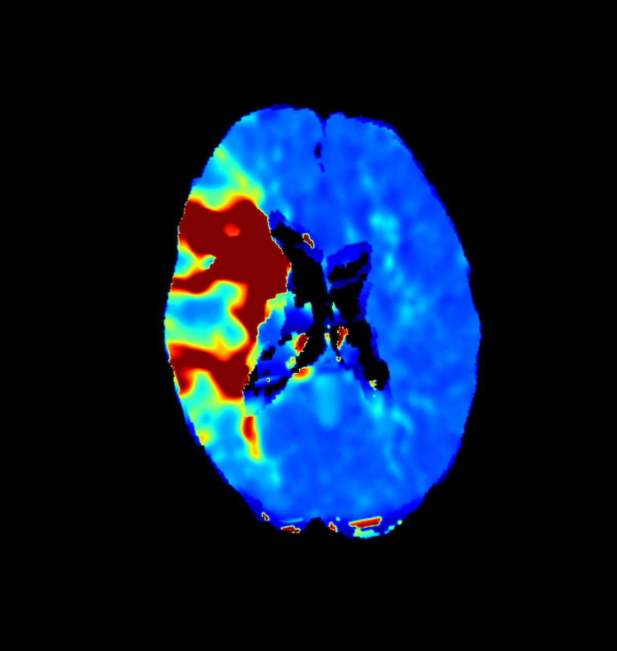 FDA Clears Cone-Beam CT Software for Real-Time Qualitative Perfusion Assessment