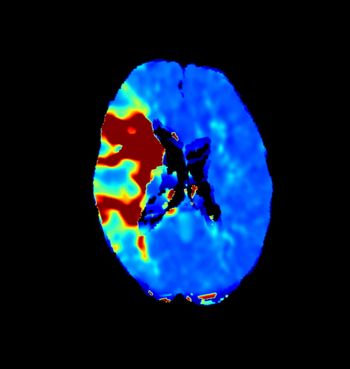 FDA Clears Cone-Beam CT Software for Real-Time Qualitative Perfusion Assessment