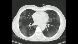 AI Software Facilitates 22.1 Percent Reduction in Chest CT Review Time