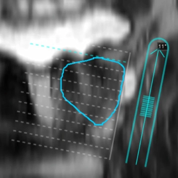 New Software Combines Pre-Op MRI Guidance with Live Ultrasound for Brachytherapy Treatment of Prostate Cancer
