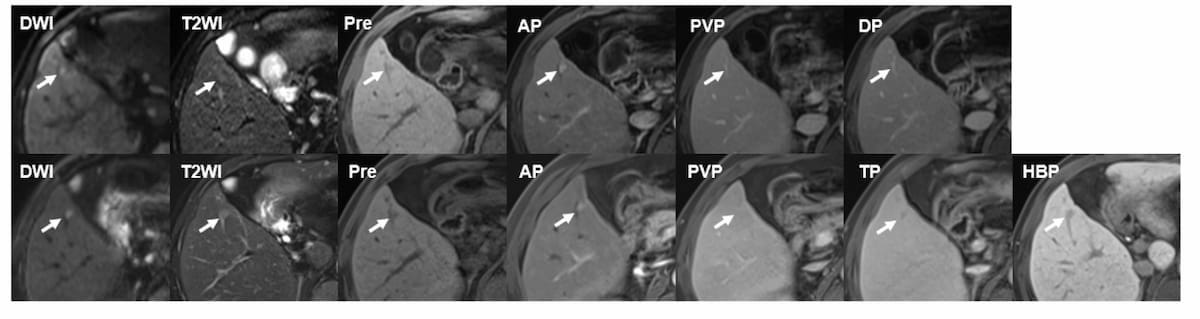 Could Risk-Stratified MRI Surveillance Supplant Semiannual Ultrasound Exams in Patients with Cirrhosis?