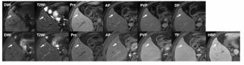 Could Risk-Stratified MRI Surveillance Supplant Semiannual Ultrasound Exams in Patients with Cirrhosis?