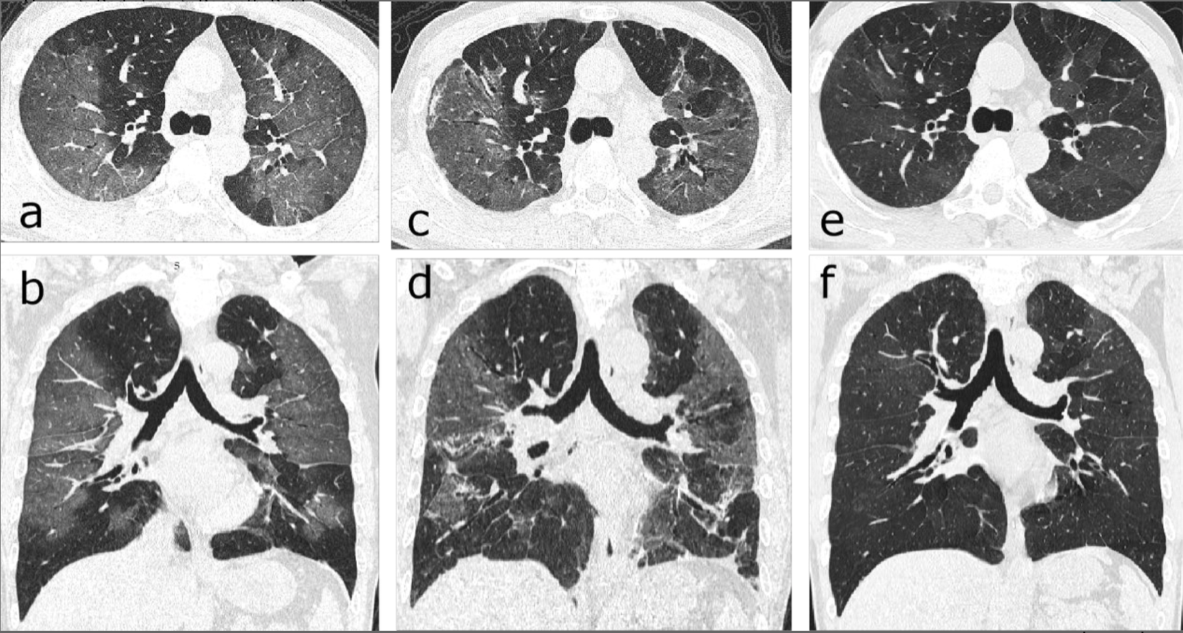 Post Covid 19 Ct Reveals Potentially Lifetime Lung Damage In One Thirds Of Patients