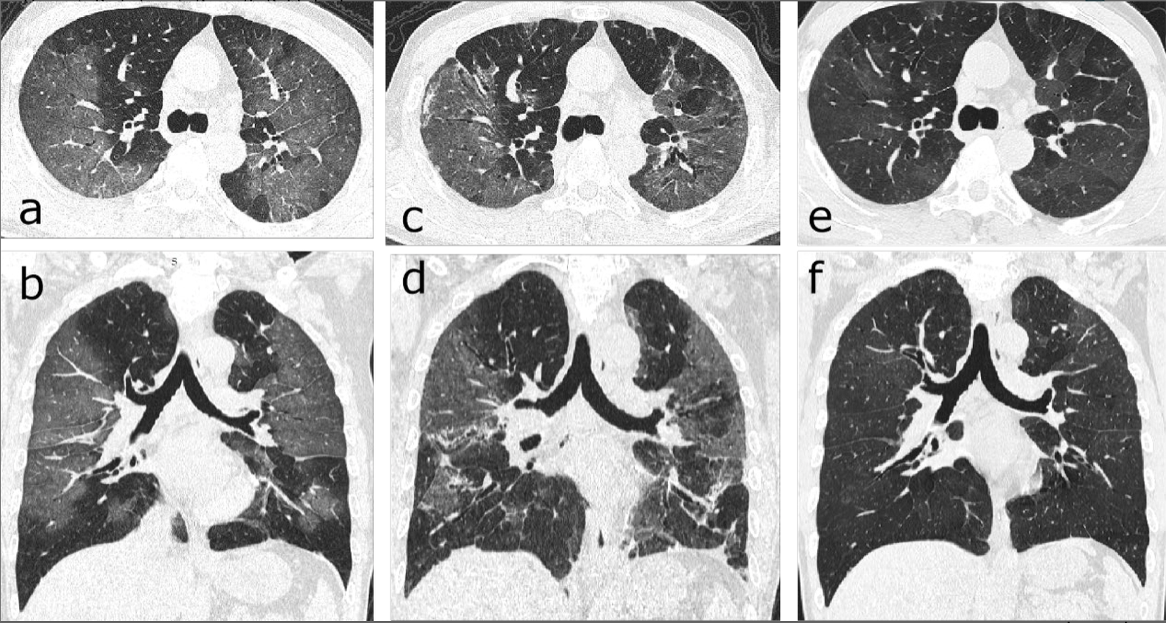 Post Covid 19 Ct Reveals Potentially Lifetime Lung Damage In One Thirds Of Patients Post Covid 19 Ct Reveals Potentially Lifetime Lung Damage In One Thirds Of Patients