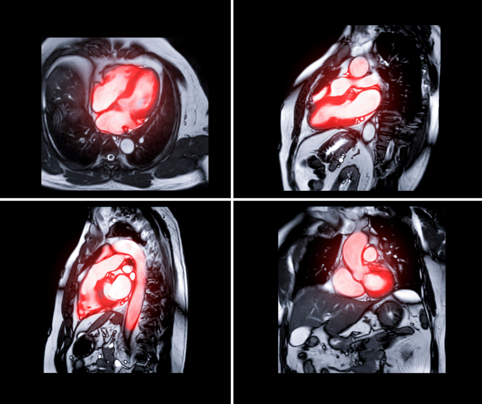 What a New Study Reveals About MRI Use and Implantable Cardioverter