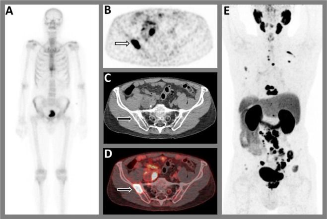 Is PSMA PET/CT More Beneficial than Bone Scintigraphy in Detecting Bone ...