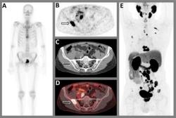 Is PSMA PET/CT More Beneficial than Bone Scintigraphy in Detecting Bone Lesions in Cases of High-Risk Prostate Cancer?