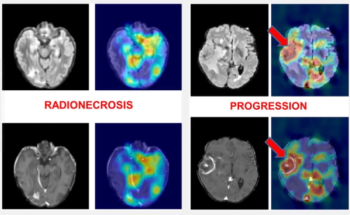 Brain MRI Study Assesses Impact of AI in Differentiating Radionecrosis from Neoplastic Progression of Metastasis