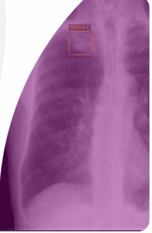 Foundation Model-Based Chest X-Ray AI Software Gets FDA Nod
