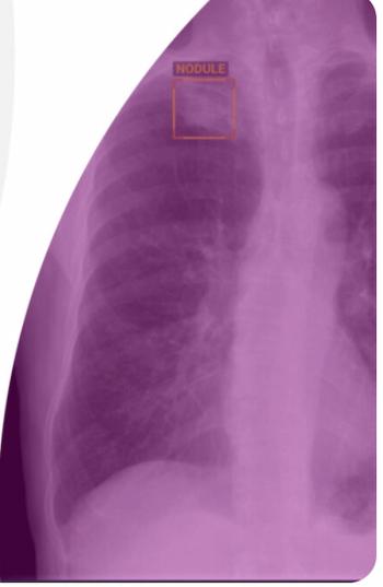 Foundation Model-Based Chest X-Ray AI Software Gets FDA Nod