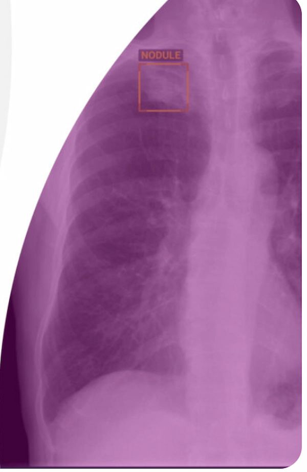 Foundation Model-Based Chest X-Ray AI Software Gets FDA Nod