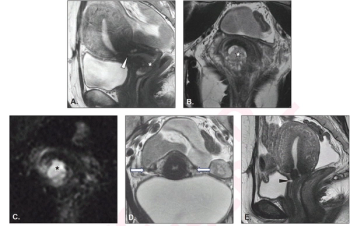 Can MRI Have an Impact with Fertility-Sparing Treatments for Endometrial and Cervical Cancers?