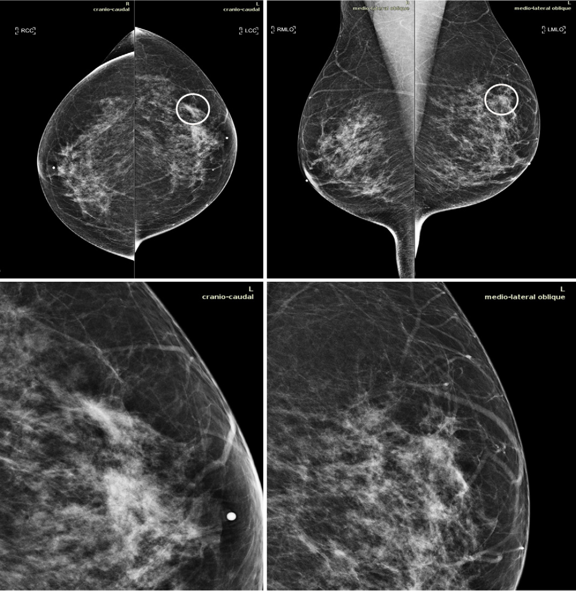 Mammography AI Tool Cleared This Year Improves Breast Cancer Detection ...