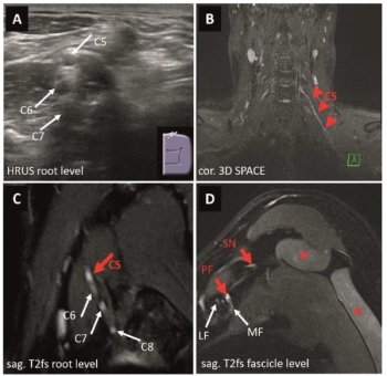 Is Ultrasound or MRI More Effective for Diagnosing Peripheral Nerve Disorders in the Upper Extremities?