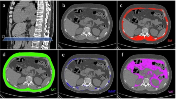 Key Chest CT Parameters for Body Composition May be Prognostic for Patients with Resectable NSCLC