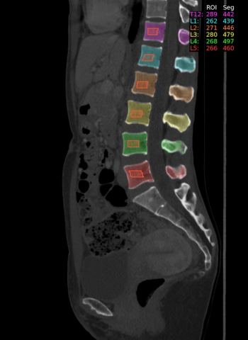FDA Clears AI-Powered Bone Mineral Density Assessment from Abdominal CT Scans