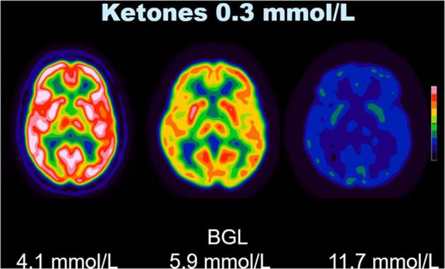Can the Keto Diet Affect PET Imaging of the Brain?