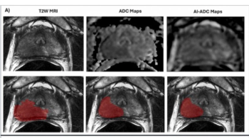 Study: AI-Generated ADC Maps from MRI More Than Double Specificity in Prostate Cancer Detection