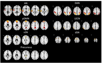 MRI Study Reveals Early Differences in Mild Cognitive Impairment Preceding Alzheimer’s Disease and Parkinson’s Disease
