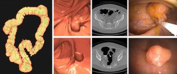 Study: CT Colonography Screening Offers Up to 16 Percent Higher Reduction of Colorectal Cancer Incidence than Cologuard