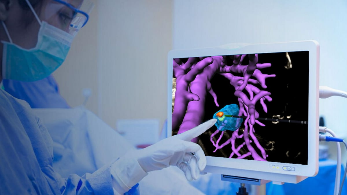 AI-Powered Liver Tumor Ablation Software Leverages CT, MRI and Ultrasound for Real-Time Image Guidance