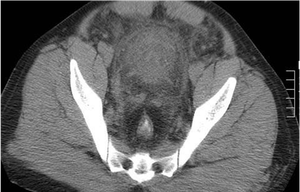 Silent Non-traumatic Extensive Aortic Dissection