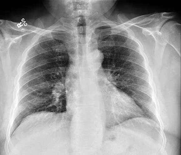 Paraesophageal Omental Hernia Mimicking Thoracic Aorta Aneurysm ...