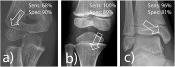 Study Suggests AI Software May Offer Standalone Value for X-Ray Detection of Pediatric Fractures