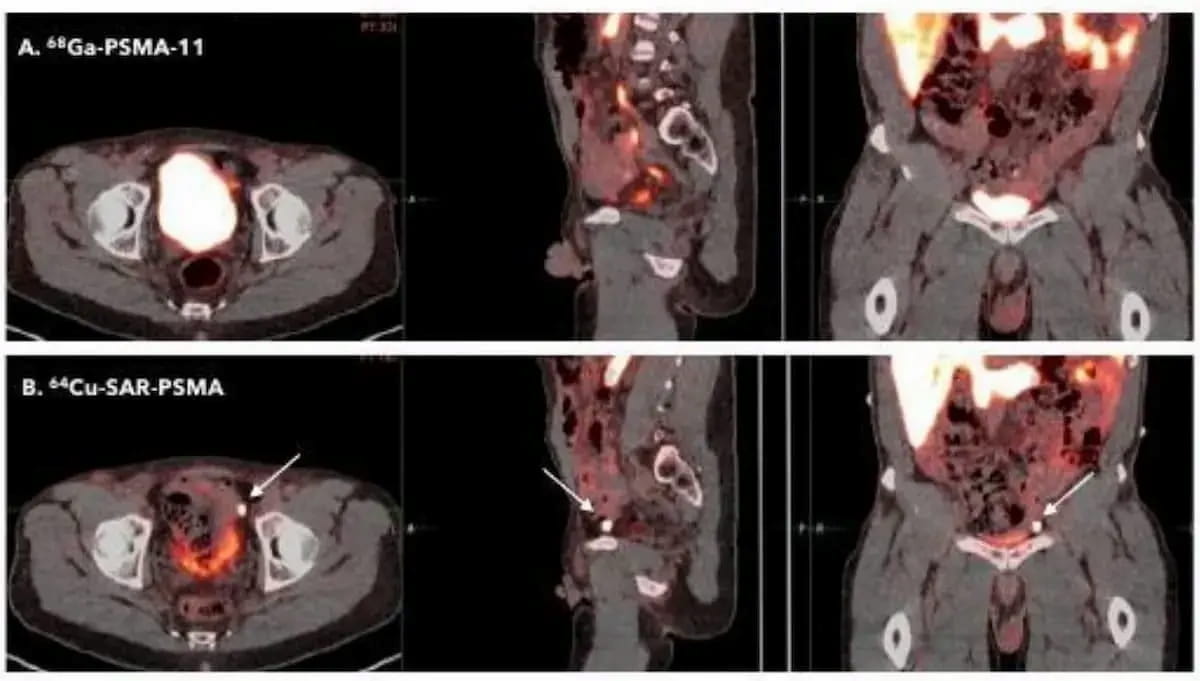 Comparative PET Imaging Trial Shows Increased Detection of PCa Recurrence with 64Cu-SAR-bisPSMA