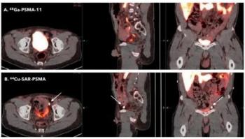 Comparative PET Imaging Trial Shows Increased Detection of PCa Recurrence with 64Cu-SAR-bisPSMA