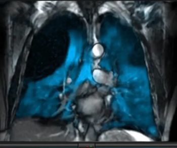 FDA Issues Expanded Pediatric Approval of MRI Contrast Agent for Lung Ventilation Assessment