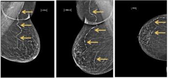 New Mammo Enhance Heart Program to Enhance Dual Screening for Breast Cancer and Cardiovascular Disease