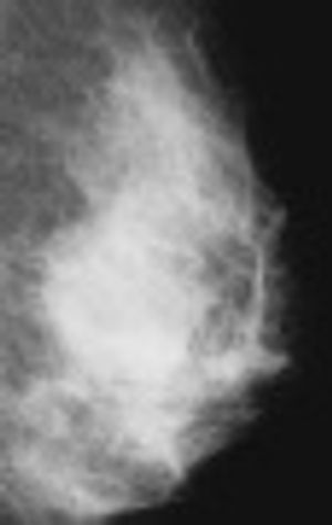 Breast Density Notification Laws Unclear On Delivery and Goal