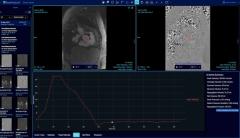 FDA Clears AI Software for Automated Measurements on Cardiac MRI
