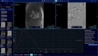 FDA Clears AI Software for Automated Measurements on Cardiac MRI