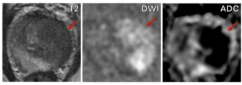 Study: Monitoring of Prostate MRI Exams Could Lead to 75 Percent Reduction of Gadolinium Contrast