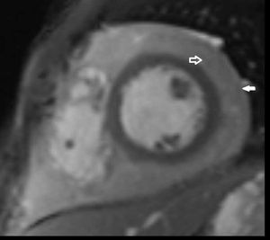 Tuberculous Pericarditis