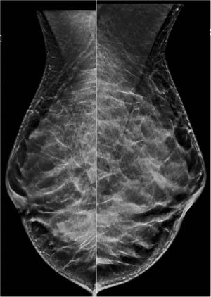 Image IQ: Screening Ultrasound for Dense Breasts