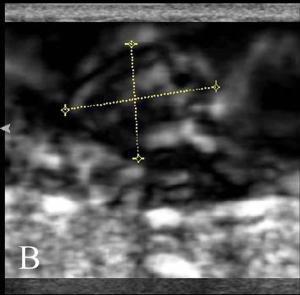Ultrasound elastography slashes needless breast biopsies