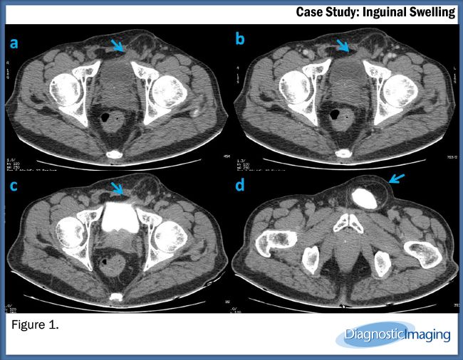 Inguinal Ligament Swelling