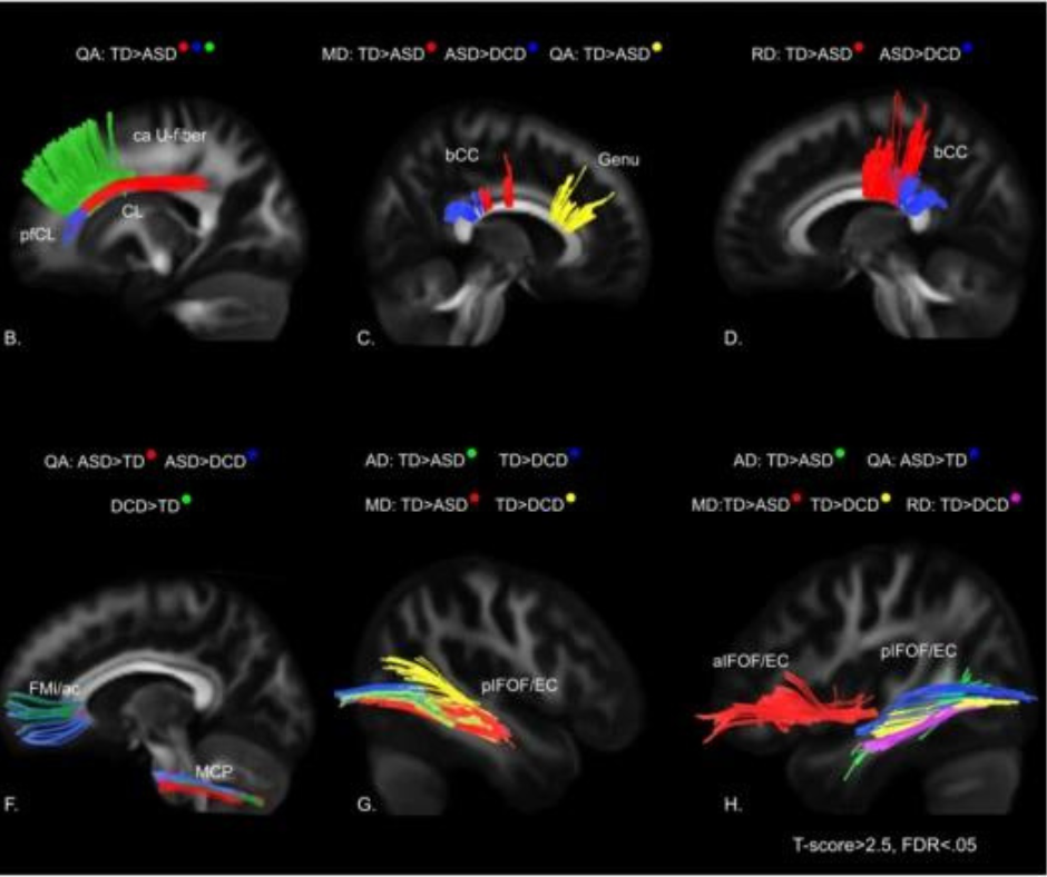 New MRI Study Identifies Signature White Matter Connectivity Patterns in People with Autism